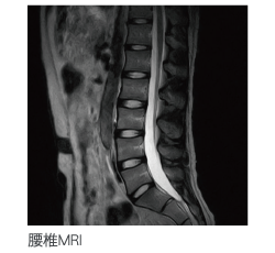 MRI 脊髄のヘルニア
