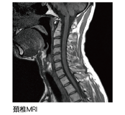 MRI 頚椎のヘルニア